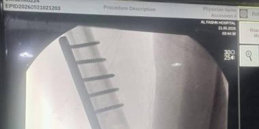 نجاح جراحة دقيقة لتثبيت كسر بالفخذ لطفل بمستشفى الفشن ببنى سويف